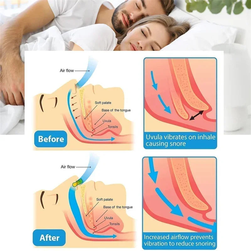 🔥 Anti-Snoring Snore Prevention Gadget Anti-Snore Device Snore Elimination Nose Sleep Night